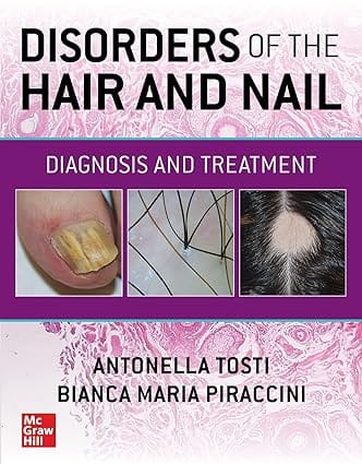 Disorders Of The Hair And Nail Diagnosis And Treatment 2024 By Tosti A