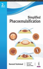 Simplified Phacoemulsification 2nd Edition 2024 By Navneet Toshniwal