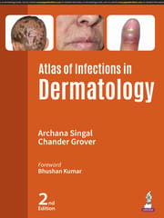 Atlas Of Infections In Dermatology 2nd Edition 2025 By Archana Singal