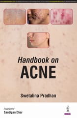 Handbook on Acne 1st Edition 2025 By Swetalina Pradhan