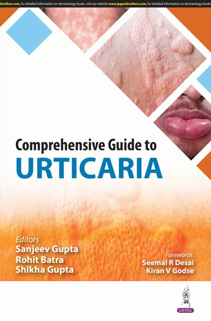 Comprehensive Guide To Urticaria 1st Edition 2025 By Sanjeev Gupta